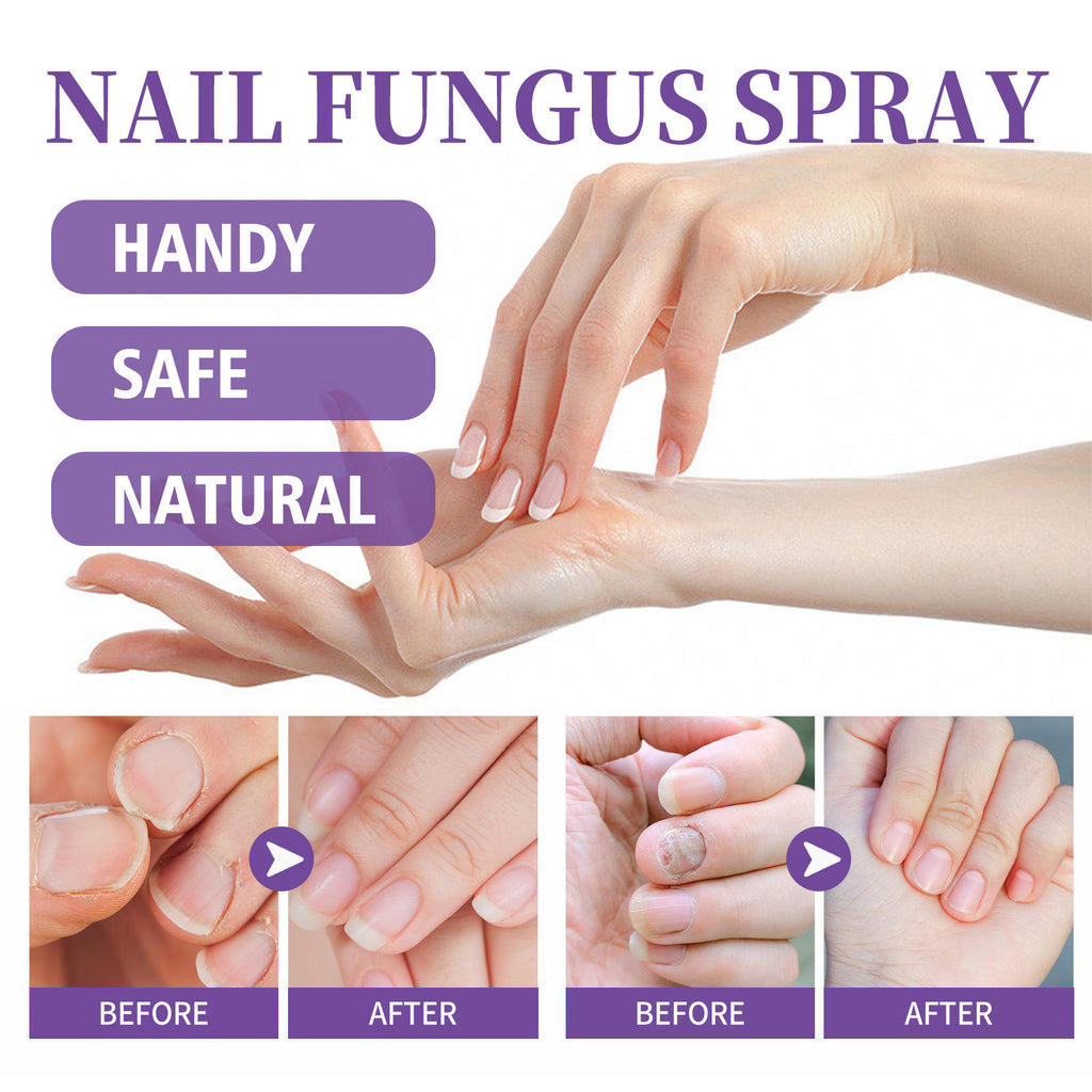 عرض 2 قطعة من NAIL FANGUS SPRAY