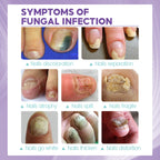عرض 2 قطعة من NAIL FANGUS SPRAY
